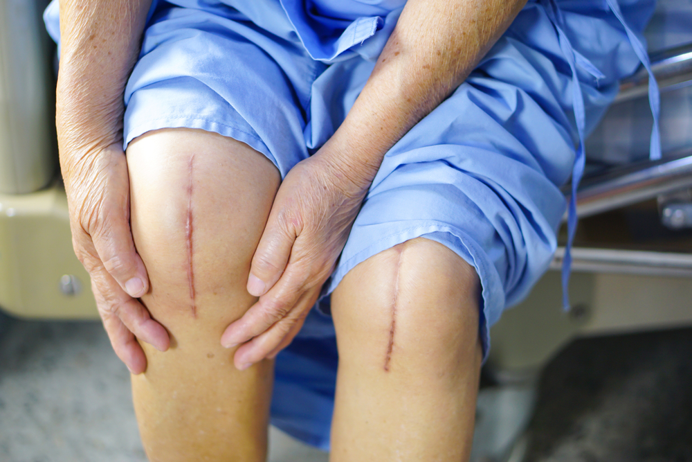 What To Expect During Knee Replacement Recovery