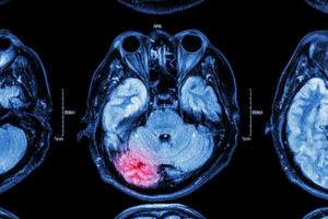 What to Expect with a Traumatic Brain Injury