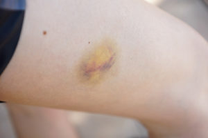 soft tissue injury