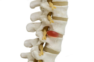 What Happens if a Herniated Disc Goes Untreated