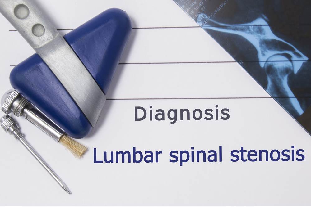 Spinal Stenosis Diagnosed