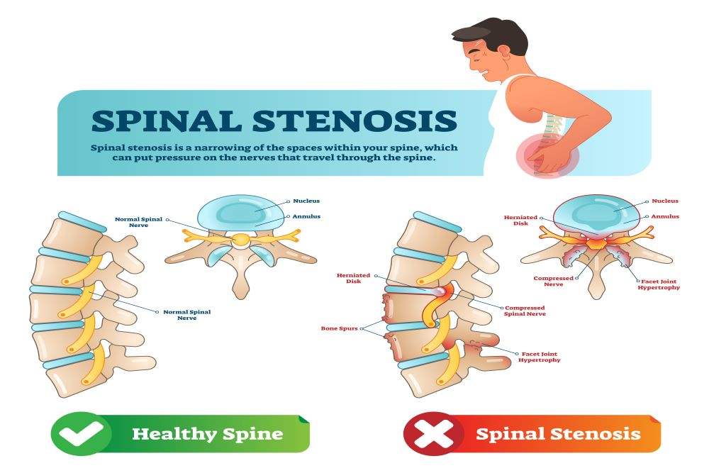 Spinal Stenosis