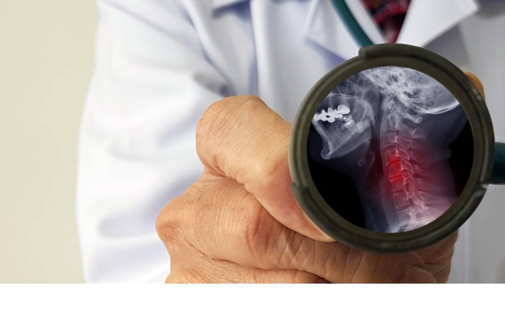 Treatment Options for Spinal Stenosis