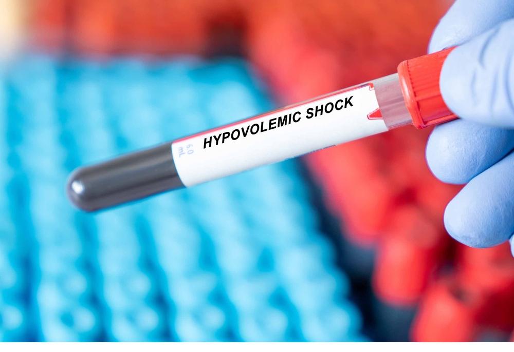 What You Need to Know About Hypovolemic Shock