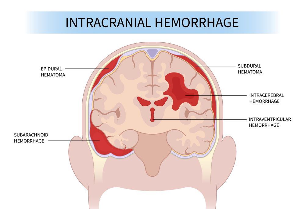 What happens during hypovolemic shock